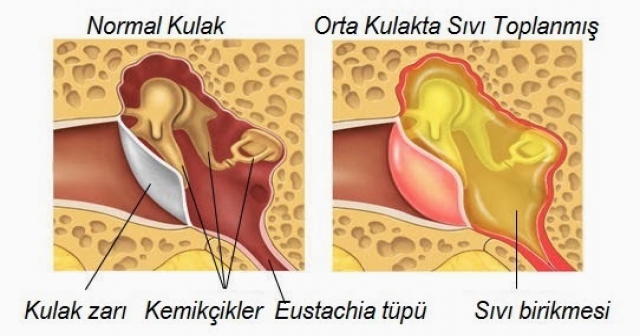 Kulakta Sıvı Birikimi Kulak Tüpü İle Tedavi Ediliyor